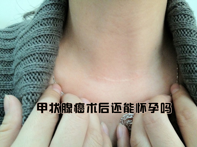 甲状腺癌术后还能怀孕吗